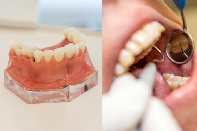 dental implants point cook